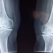 artrosis de rodilla_ Dr. Lluis Puig Verdié_ prótesis_Barcelona