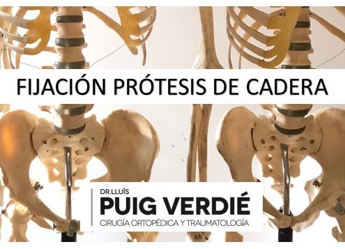 fijación de prótesis de cadera _Dr. Lluís Puig Verdié_cirugía ortopédica y traumatología