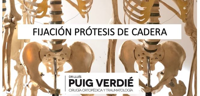 fijación de prótesis de cadera _Dr. Lluís Puig Verdié_cirugía ortopédica y traumatología