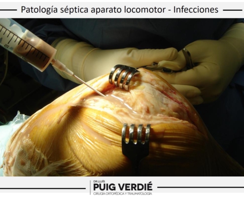 Dr. lluís Puig Verdié especialista en infecciones de prótesis, hueso y articulaciones