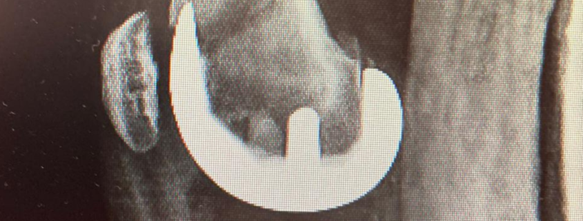 fractura periprotésica de rodilla por el Dr. Lluís Puig Verdié