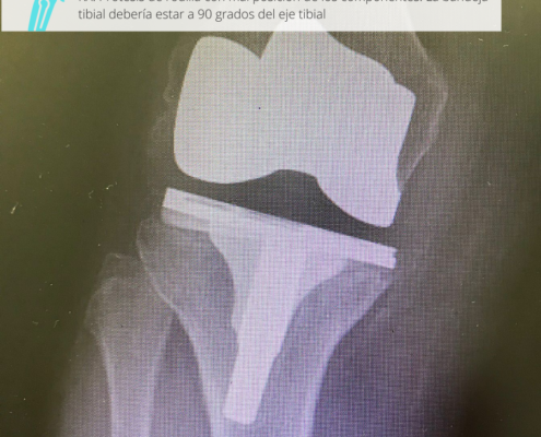 Prótesis de rodill dolorosa por el Dr. Lluís Puig Verdié traumatólog experto en cirugía de rodilla y protesis e infecciones