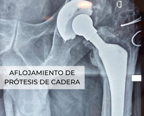 Aflojamiento de prótesis de cadera Dr. Lluís Puig Verdié cirujano experto en próteiss de cadera