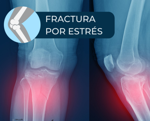 fractura por estrés de tibia Dr. Lluís Puig Verdié traumatólogo experto en prótesis rodilla