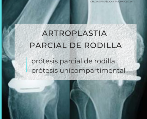 artroplastia parcial de rodilla por el Dr. Lluís Puig Verdié experto en prótesis de rodilla en Barcelona